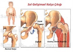 dogustan-kalca-cikigi.jpg