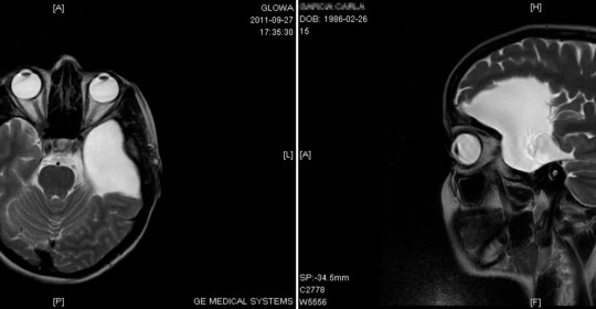 arachnoid-mri-540x280.jpg