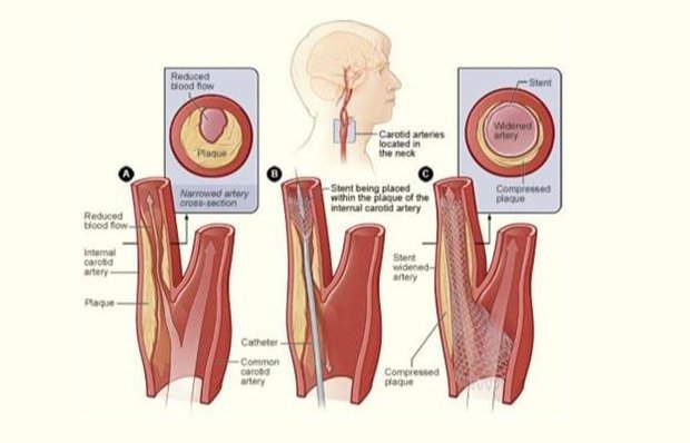 sah-damari-darligi-stent.jpg